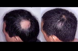 Alopecia Areata Treatment Clinic in Dubai & Abu Dhabi