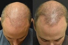 Best ACell PRP Therapy Hair Loss Clinic in Dubai