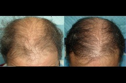 Best ACell PRP Therapy Hair Loss in Dubai & Abu Dhabi