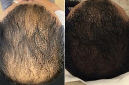 Best ACell PRP Therapy Hair Loss in Dubai