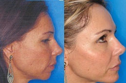 Best Chin Reduction Clinic in Dubai