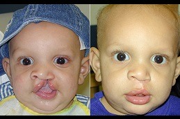 Best Cleft Lip and Palate Surgery in Dubai