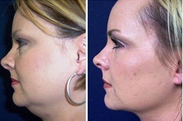 Best Double Chin Removal Clinic in Dubai