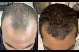 Best Hair Fall Treatments in Dubai