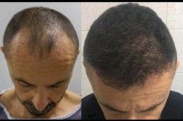 Best Hair Implants Clinic in Dubai