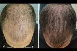 Best Hair Loss Treatment in Dubai