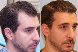 Best Hair Restoration in Dubai