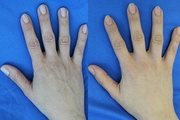 Best Hand Rejuvenation Clinic in Dubai & Abu Dhabi