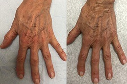 Best Hand Rejuvenation Clinic in Dubai