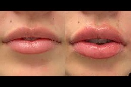 Best Lip Enlargement in Dubai