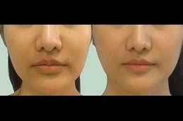 Best Lip Reduction Surgery in Dubai