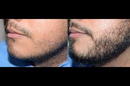 Best Mustache Hair Transplant in Dubai
