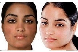 Best Permanent Skin Whitening Treatment Clinic in Dubai & Abu Dhabi