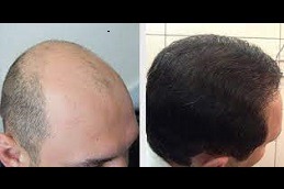 Best Scarless Hair Transplant in Dubai