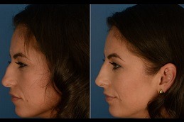 Best Silicone Nose Surgery Clinic in Dubai & Abu Dhabi