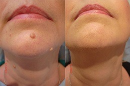 Best Skin Lesion Removal Clinic in Dubai