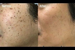 Best Skin Lesion Removal in Dubai