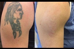 Best laser tattoo removal Clinic in Dubai