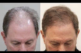 Best sideburn hair transplant Clinic in Dubai