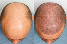 Best sideburn hair transplant in Dubai