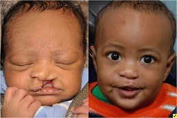 Cleft Lip and Palate Surgery Clinic in Abu Dhabi