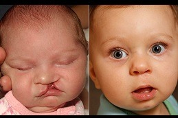 Cleft Lip and Palate Surgery in Dubai