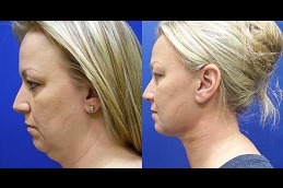 Double Chin Removal Clinic in Abu Dhabi