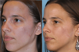 Facial Scar Revision in Dubai