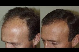 Fuss Hair Transplant in Dubai