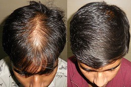 Hair Fall Treatments Clinic in Abu Dhabi