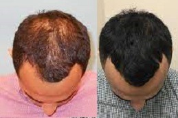 Hair Fall Treatments in Dubai