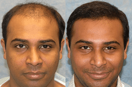 Hair Transplant Cost in Dubai