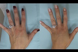 Hand Rejuvenation Clinic in Abu Dhabi