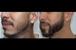 Mustache Hair Transplant Clinic in Abu Dhabi