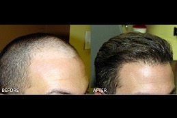 Natural Hairline Treatment Clinic in Dubai & Abu Dhabi