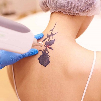 Picosure Laser Tattoo Removal in Dubai & Abu Dhabi Enlighten PICO Cost
