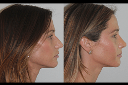 Septoplasty and Turbinate Reduction Clinic in Abu Dhabi
