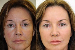 Stem Cell Facelift Treatment Clinic in Abu Dhabi