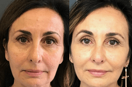 Stem Cell Facelift Treatment in Dubai