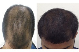 growth factor concentrate for hair loss Clinic in Abu Dhabi