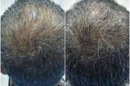 growth factor concentrate for hair loss in Dubai