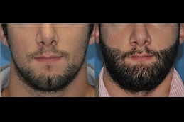 Beard Hair Transplant Cost in Dubai