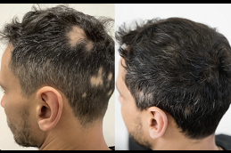 Best Alopecia Areata Treatment Cost Clinic in Dubai