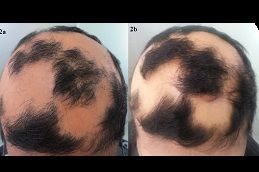 Best Alopecia Areata Treatment Cost in Dubai