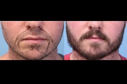 Best Beard Hair Transplant Cost in Dubai