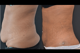 Best Bodytite Liposuction Clinic in Dubai