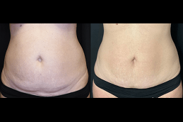 Best Bodytite Liposuction in Dubai