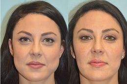 Best Buccal Fat Removal Clinic in Dubai