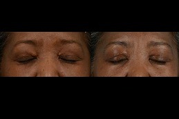 Best Eyelid Xanthelasma Removal Clinic in Dubai