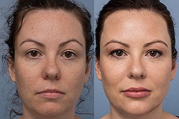 Best Face Filler Injections Cost Clinic in Dubai